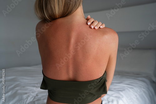Εκτύπωση καμβά Young woman touching sunburned back with irritated skin and mild allergic rash after sun exposure