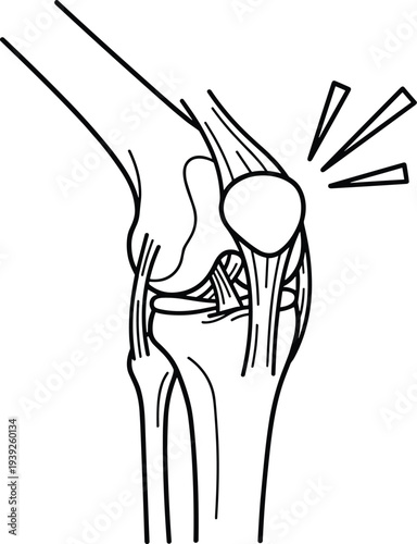 A medical illustration of a knee joint with pain or injury indicated by lines radiating from the area