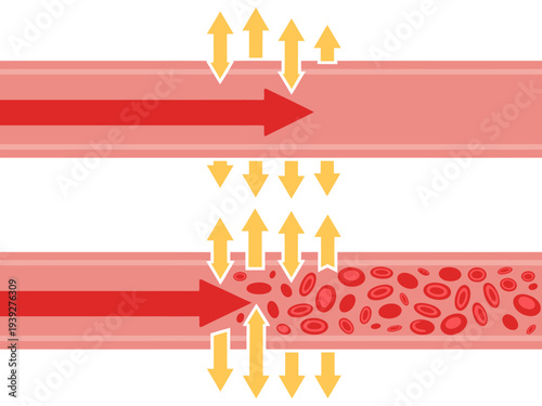 Blood flow through arteries with and without blockage  health concept