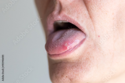 Canker sore on tongue close-up showing painful oral ulcer