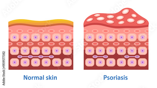 Comparison of normal skin and psoriasis skin layers anatomy
