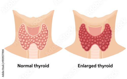 Normal and enlarged thyroid gland comparison in human neck