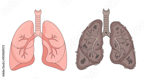 Healthy Lungs Compared to Damaged Lungs in Medical Illustration