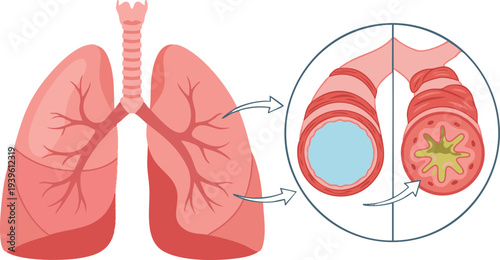 Understanding Asthma A Visual Guide to Bronchial Inflammation and Airway Narrowing