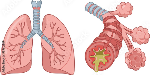 Detailed medical illustration of the human respiratory system showing healthy lungs and a magnified view of alveoli with mucus buildup