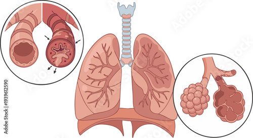 Vector Diagram of Human Lungs Illustrating Respiratory System Anatomy with Detailed Views of Bronchi, Alveoli, and Comparison of Healthy, Inflamed Airways