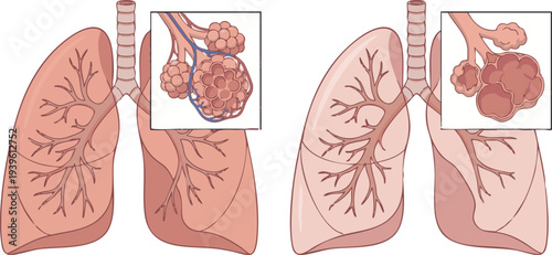 Healthy Lungs versus Lungs with Pneumonia, Illustrating Alveoli Damage