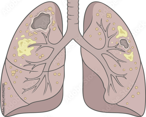 Detailed Medical Illustration Depicting Diseased Human Lungs with Visible Nodules and Lesions, Highlighting Respiratory Illness and Health Issues