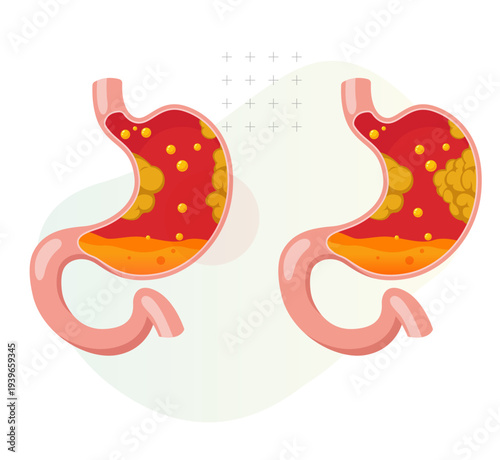 Stomach Tumour Growth - Gastric Cancer - Stock Illustration