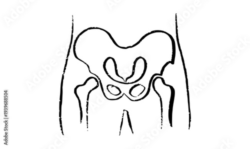 Osteomyelitis disease sketch