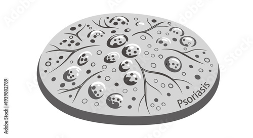 Psoriasis skin condition medical illustration showing inflamed patches and scales.