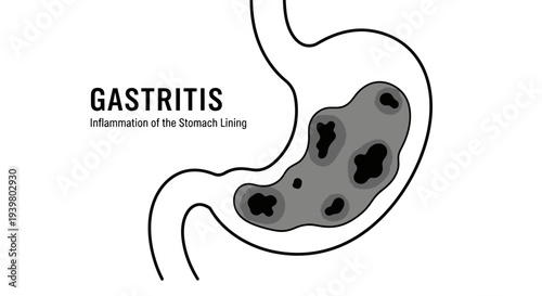 Medical illustration of Gastritis showing inflammation of the stomach lining in line art style.