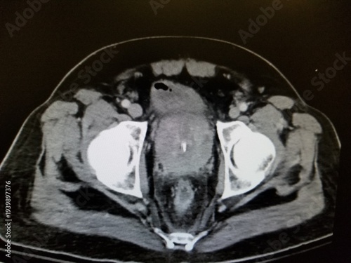 CT pelvis showing prostatic enlargement and femoral heads