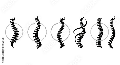 Human spine illustrations showing different curvatures and deformities.