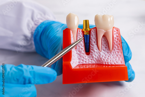 Canvastavla Gros plan sur un dentiste pointant avec son stylo la vis d'un schéma 3D d'implant dentaire
