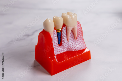 Gros plan sur un schéma d'implant dentaire.