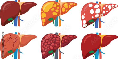 Human liver disease stages illustration, healthy liver to fatty liver and cirrhosis medical anatomy vector healthcare infographic set