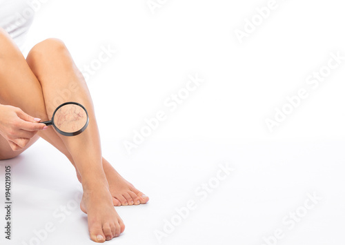 Beautiful slender woman sits on a couch in a spa salon. She shows varicose veins in the lower legs.Treatment of varicose veins and capillaries.