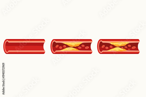 Medical Vector Illustration of Three Stages of Atherosclerosis in a Coronary Artery Showing Plaque Buildup, Cholesterol Accumulation, and Narrowing of Blood Vessels for Healthcare Education.