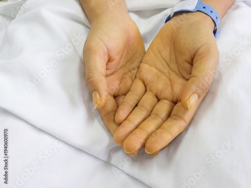 Hepatitis (Jaundice): Professional photography, close-up of yellowing skin on hands against a white sheet, medical accuracy, sharp focus.