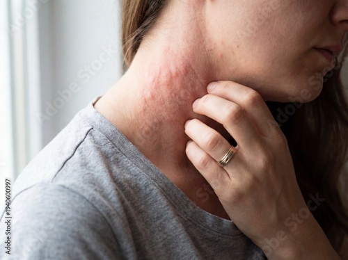 Allergic Reaction (Hives): Professional photography, close-up of raised red welts on a neck, person scratching, bright natural light, sharp focus.