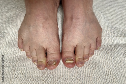 Onychomycosis. Process of hardware treatment of toenails by a doctor with various diamond feathers. Dangerous fungal infection of toenails in person sitting in an examination chair. Regular cleaning