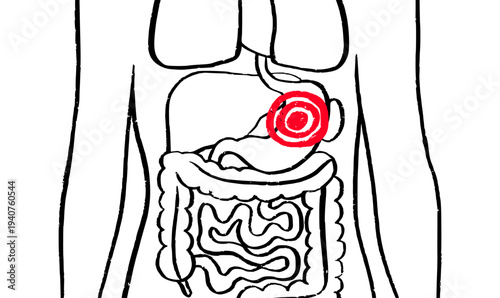 Gastroesophageal reflux pain
