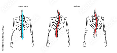 Scoliosis spine deformity