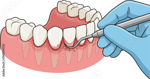 Dentist examining gum recession with a dental instrument, close-up of teeth and gums