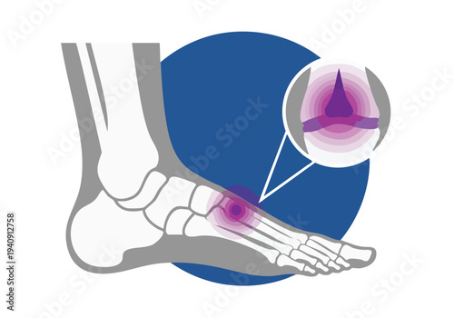Foot Anatomy. Painful Joint. Inflammation Highlighted.