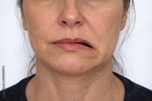 Foto A close‑up of the lower face showing asymmetric mouth positioning with one corner pulled downward, highlighting facial droop and clinical evaluation of nerve‑related facial changes