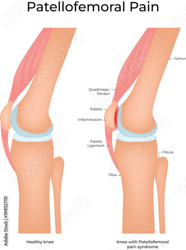 Patellofemoral Pain Syndrome Knee Anatomy Medical Vector Illustration
