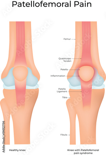 Patellofemoral Pain Syndrome Knee Anatomy Medical Vector Illustration