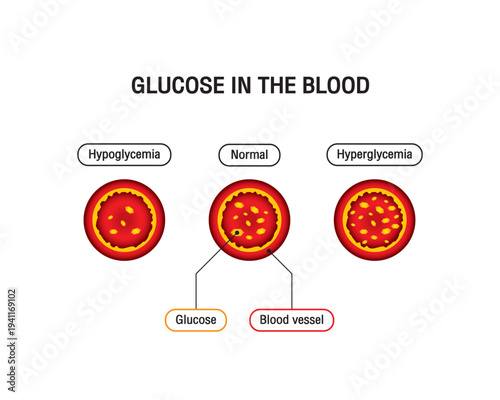 Hyperglycemia, High Blood Sugar and Diabetes ,obesity is a serious medical condition causes, vector design.
