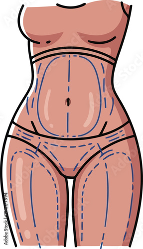 Female torso with liposuction surgery markings vector illustration