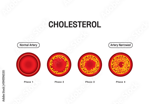 Cholesterol in the arteries, health risks, vector design.