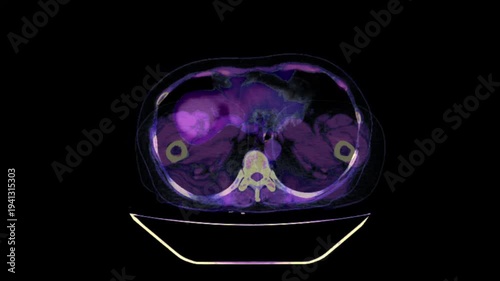 Nephrolithiasis, kidney stones abdomen ct scan
