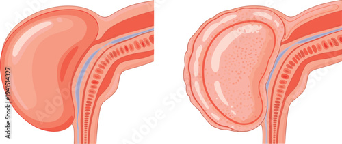 Prostate enlargement comparison healthy prostate and enlarged prostate medical anatomy illustration showing benign prostatic hyperplasia condition vector