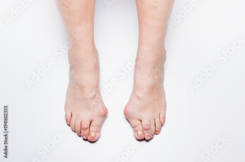Fotografía Feet with Bunions Close-Up View Isolated White Backgrouund Hallux Valgus