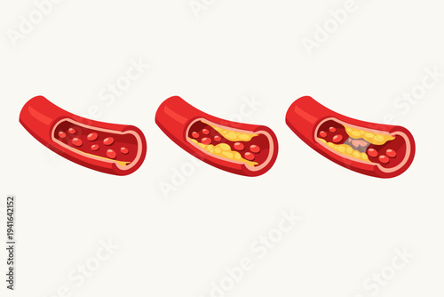 Vector illustration showing three stages of coronary artery disease: healthy artery with normal blood flow, plaque buildup narrowing the vessel, and a complete blockage caused by a blood clot.