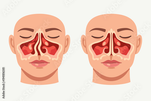 Medical Vector Illustration of Human Face Cross-Section Comparing a Normal Nasal Septum with a Deviated Nasal Septum, Showing Sinus Anatomy for Healthcare Education, Diagnosis, and Septoplasty