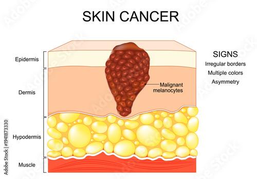 Melanoma. Skin cancer originates from melanocytes