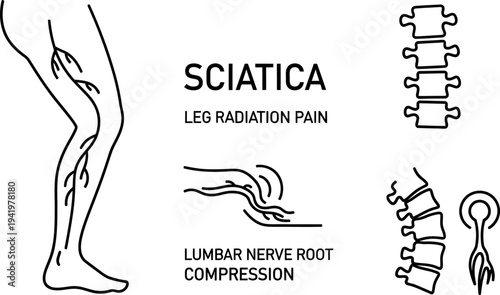 Detailed Medical Outline Illustration Explaining Sciatica Leg Radiation Pain and Lumbar Nerve Root Compression in Spinal Anatomy
