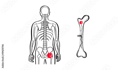 Osteomyelitis disease sketch