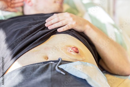 Patient showing simulated colostomy stoma on abdomen during clinical nursing training and medical education