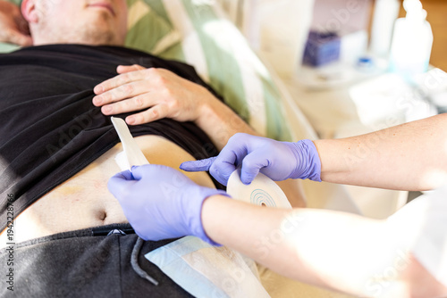 Nurse measuring ostomy baseplate size around patient stoma during ostomy care and medical treatment