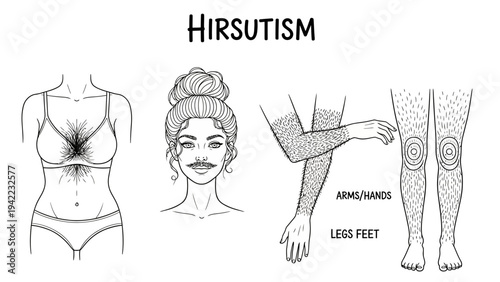 Medical illustration set depicting female bodies with abnormal and excessive hair growth across chest, face, and limbs, representing a common endocrine condition