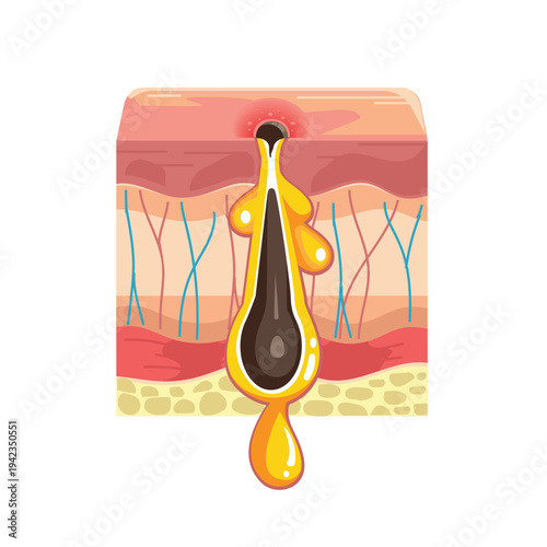 Illustration of Skin Pore Blockage and How a Blackhead forms Process on Skin