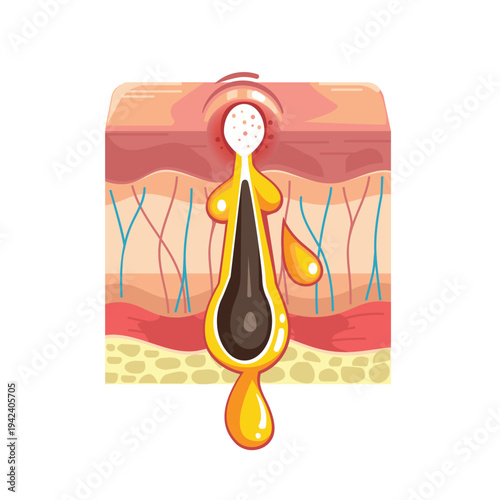 Whitehead Formation in Hair Follicle Skin Anatomy