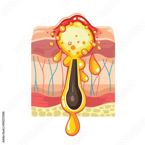Illustration of Pimple Process